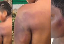 പണം മോഷ്ടിച്ചെന്ന് ആരോപണം; ഭിന്നശേഷി വിദ്യാർഥിക്ക് അധ്യാപകൻ്റെ ക്രൂര മർദനം