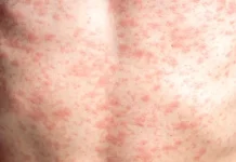 മീസിൽസ് കേസുകൾ വർധിക്കുന്നു; ആരോഗ്യ സംഘടനകളുടെ ജാഗ്രതാ നിർദ്ദേശം