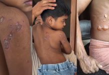 ചുട്ടുപൊള്ളി സംസ്ഥാനം: മലപ്പുറത്ത് കുട്ടികൾക്കും യുവാവിനും സൂര്യാതപമേറ്റു