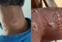 കൊടും ചൂടിൽ ഉരുകി കേരളം; ഇന്ന് സൂര്യാഘാതമേറ്റ് രണ്ട് മരണമെന്ന് സംശയം; വടക്കൻ കേരളത്തിൽ വ്യാപകമായി സൂര്യാതപമേറ്റ് പരിക്ക്